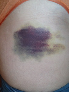 Nice Bruise on Feli's hip